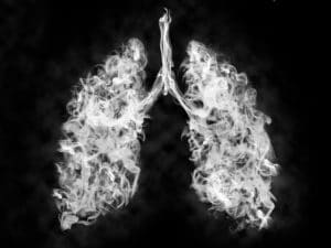 Asbestos-related lung cancer