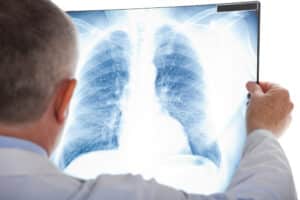 lung cancer